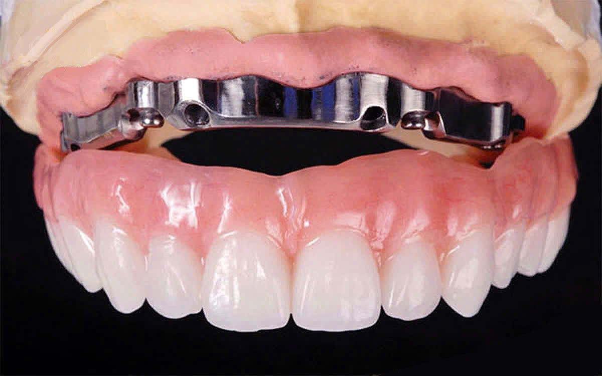 Bảo Hành Răng Sứ Nha Khoa