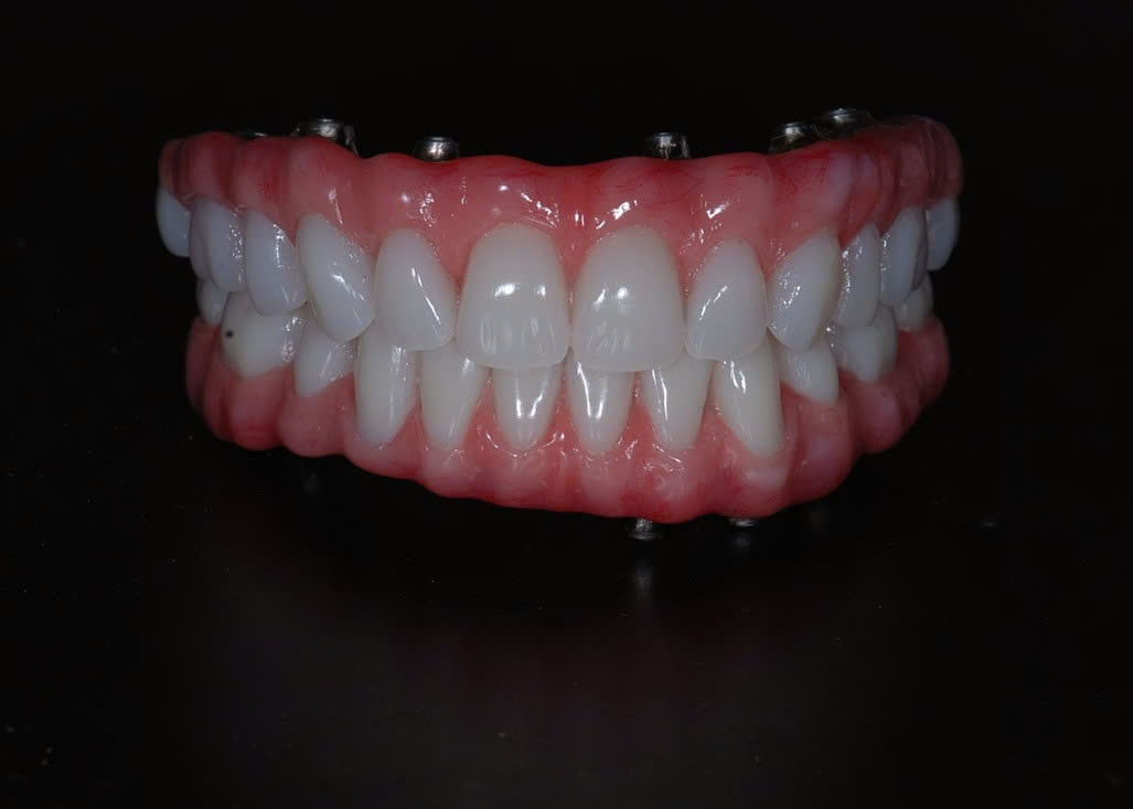 Bảo Hành Răng Sứ Nha Khoa